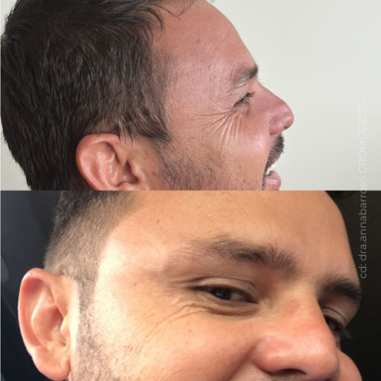 Antes e Depois 35